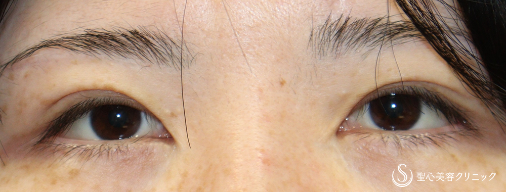 【40代女性・平行型の二重に】目上切開（1週間後） Before 