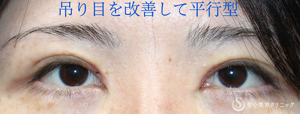 【40代女性・平行型の二重に】目上切開（1週間後） After 