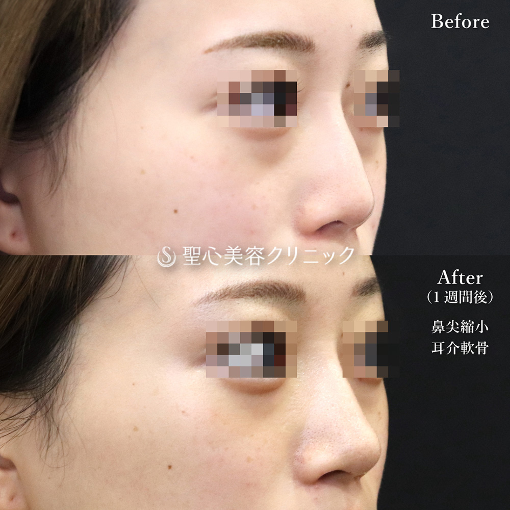 【20代女性・横から見た鼻のラインも綺麗】鼻尖縮小＋鼻尖形成（耳介軟骨移植）（1週間後） Before 