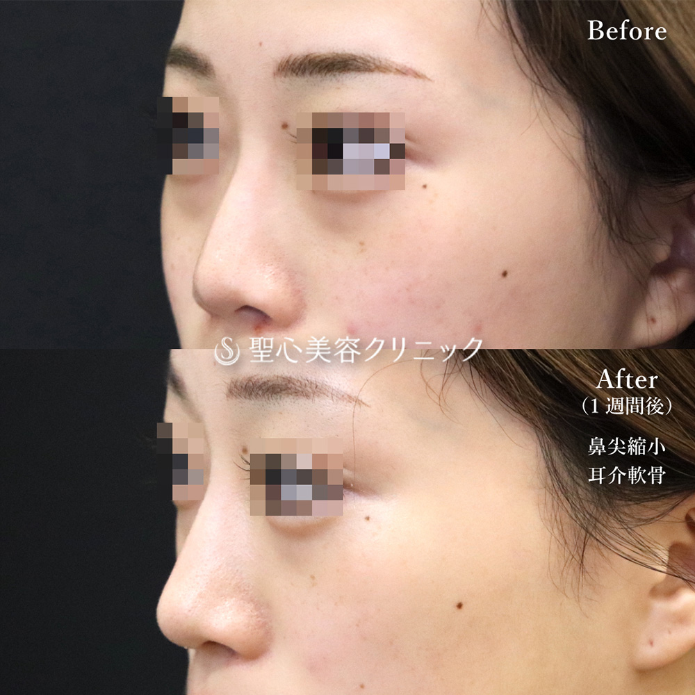 【20代女性・横から見た鼻のラインも綺麗】鼻尖縮小＋鼻尖形成（耳介軟骨移植）（1週間後） After 
