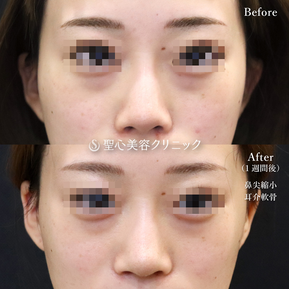 【20代女性・横から見た鼻のラインも綺麗】鼻尖縮小＋鼻尖形成（耳介軟骨移植）（1週間後） After 