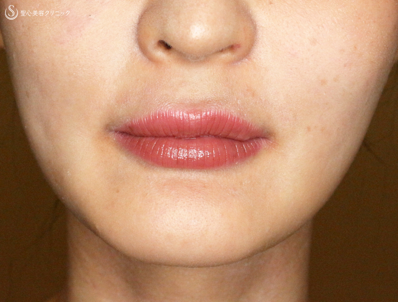 【20代女性・ヒアルロン酸だけで人中短縮効果】スマイルリップ注入レスチレン・リド（直後〜6ヶ月後） After 
