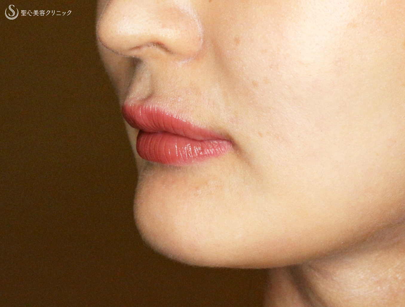 【20代女性・ヒアルロン酸だけで人中短縮効果】スマイルリップ注入レスチレン・リド（直後〜6ヶ月後） After 