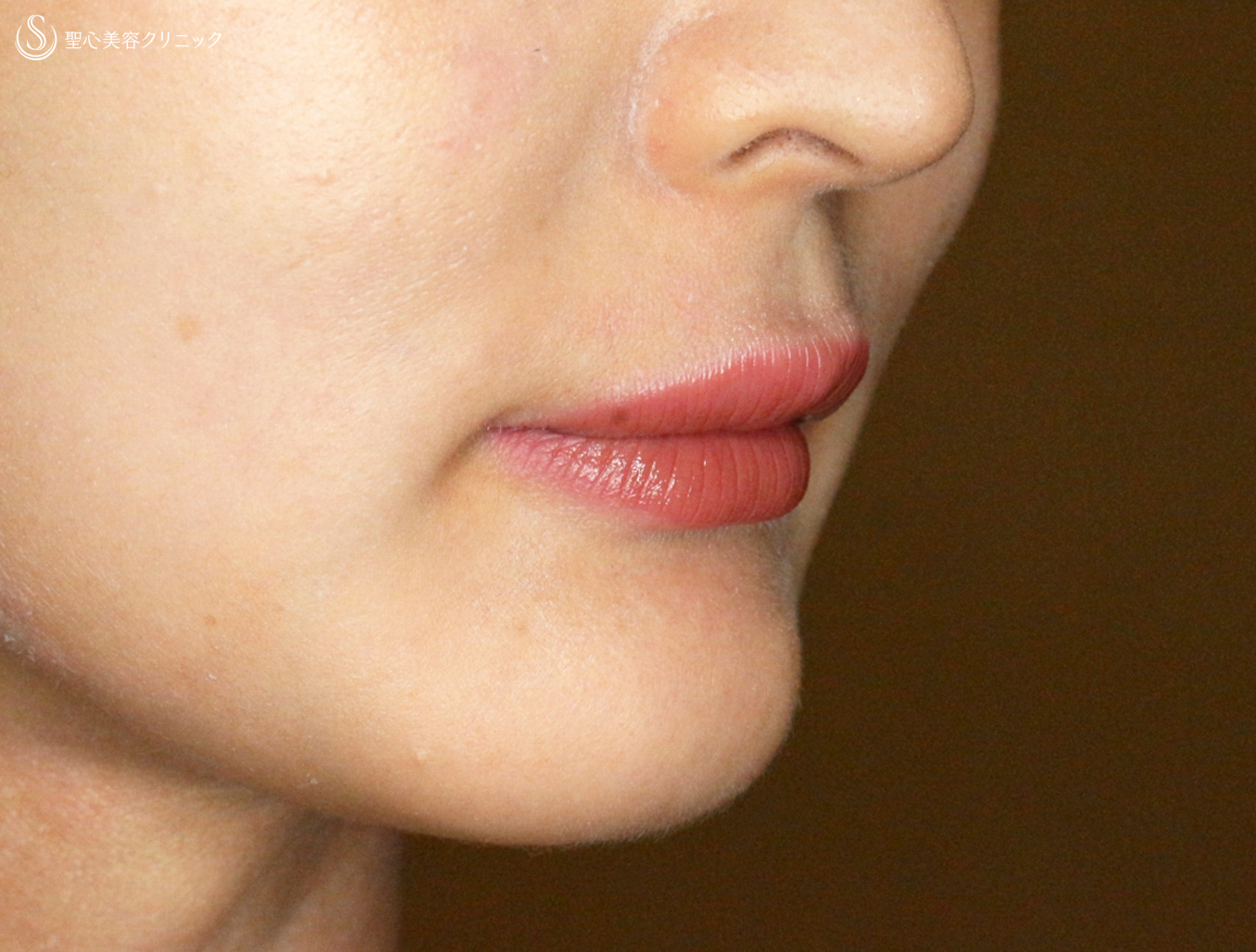 【20代女性・ヒアルロン酸だけで人中短縮効果】スマイルリップ注入レスチレン・リド（直後〜6ヶ月後） After 