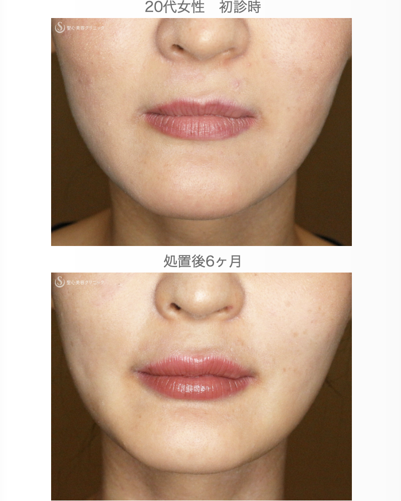 【20代女性・ヒアルロン酸だけで人中短縮効果】スマイルリップ注入レスチレン・リド（直後〜6ヶ月後） After 