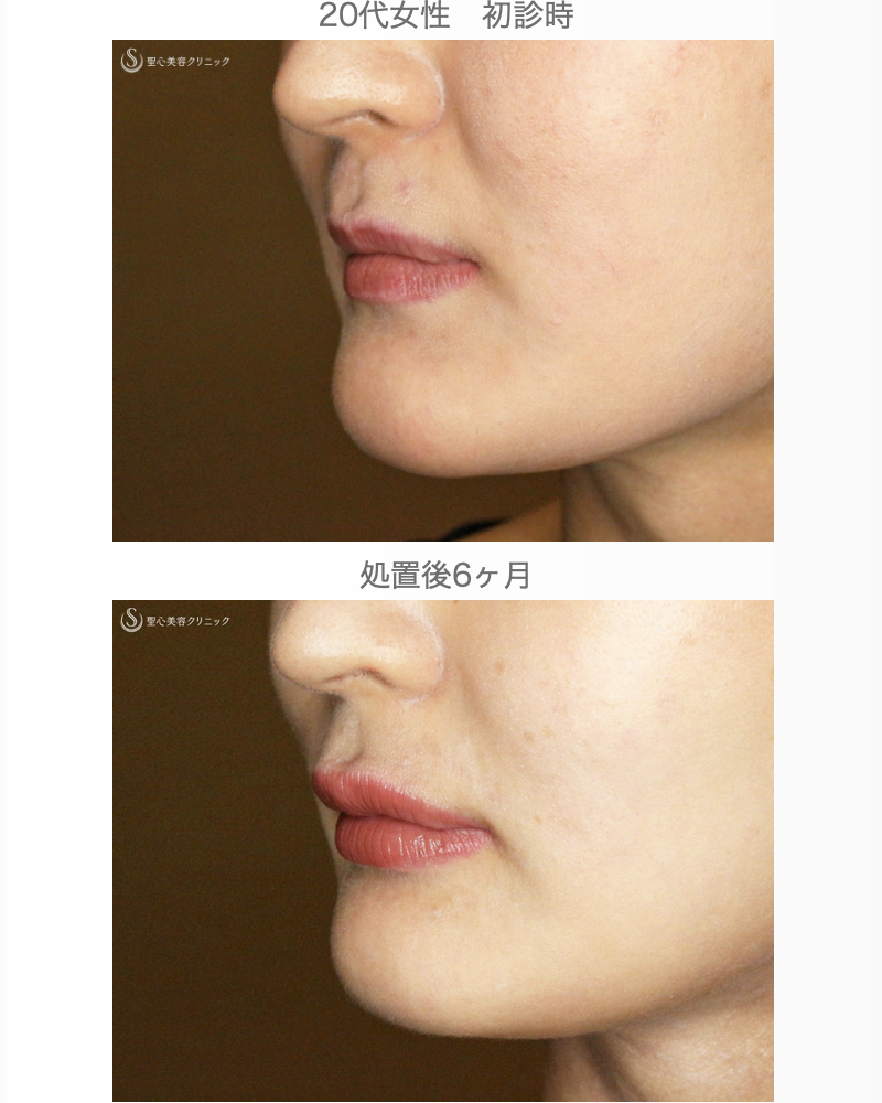 【20代女性・ヒアルロン酸だけで人中短縮効果】スマイルリップ注入レスチレン・リド（直後〜6ヶ月後） After 