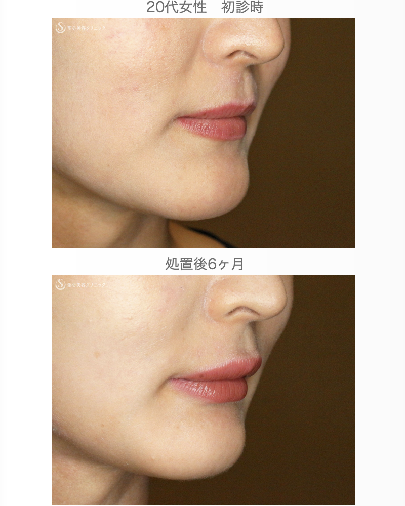 【20代女性・ヒアルロン酸だけで人中短縮効果】スマイルリップ注入レスチレン・リド（直後〜6ヶ月後） After 