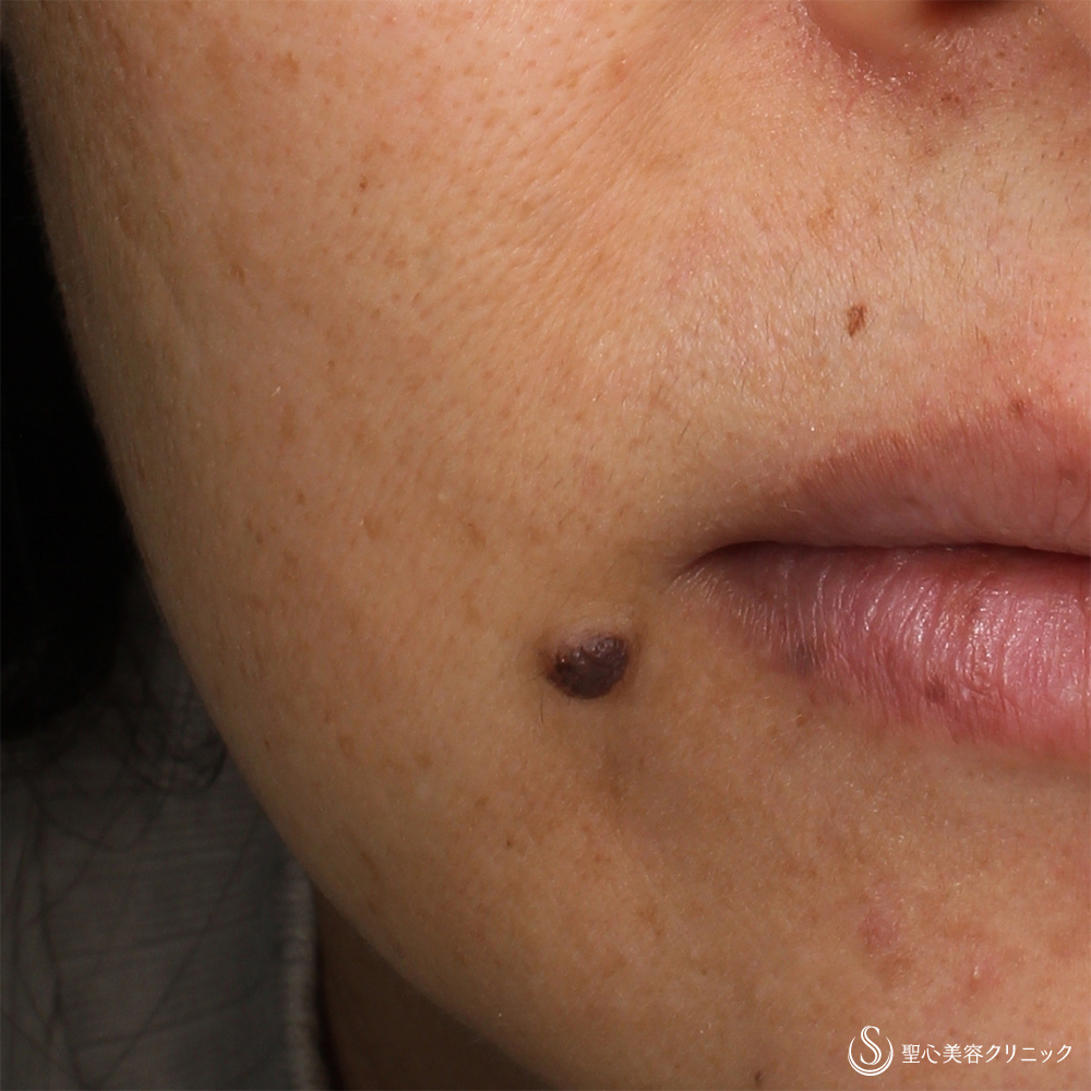 【40代女性・口元のホクロ】ホクロ除去（6ヶ月後） Before 