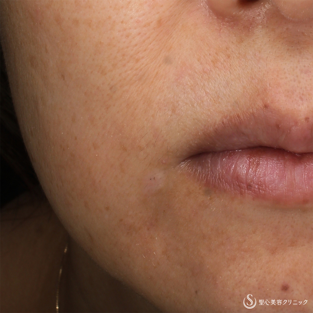 【40代女性・口元のホクロ】ホクロ除去（6ヶ月後） After 