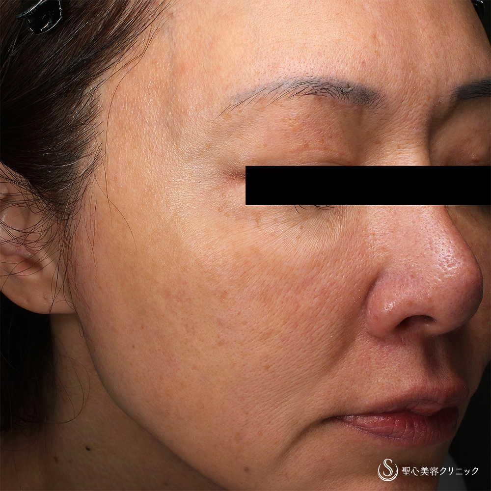 【50代女性・肌質改善】水光注射（1回後） Before 