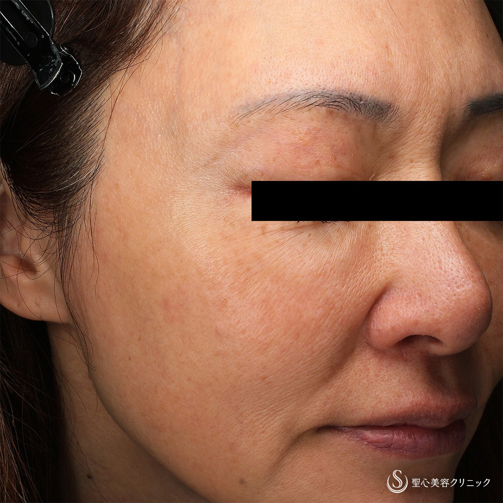 【50代女性・肌質改善】水光注射（1回後） After 