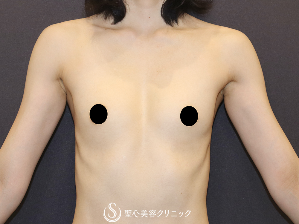 【30代女性・理想のバストを実現】バッグプロテーゼ挿入法（モティバ・エルゴノミクス2Mini155cc）（1ヶ月後） Before 