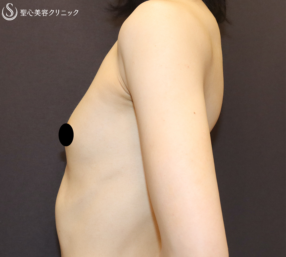 【30代女性・理想のバストを実現】バッグプロテーゼ挿入法（モティバ・エルゴノミクス2Mini155cc）（1ヶ月後） Before 
