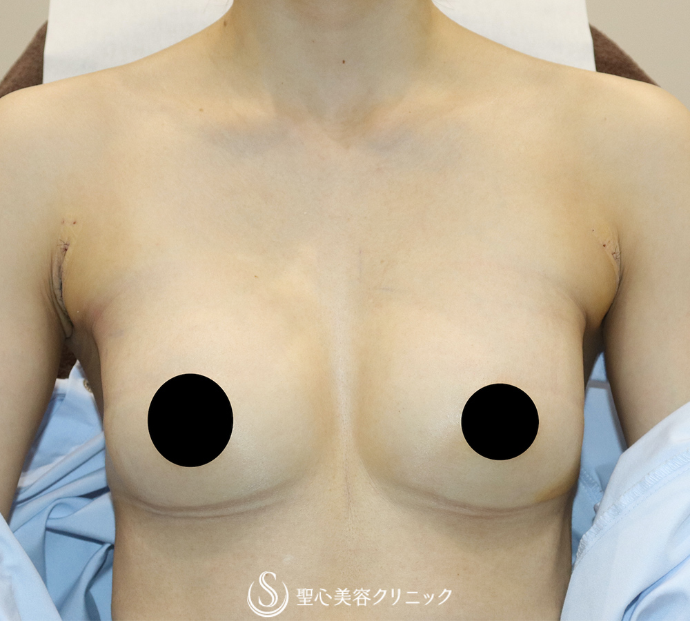 【30代女性・理想のバストを実現】バッグプロテーゼ挿入法（モティバ・エルゴノミクス2Mini155cc）（1ヶ月後） After 