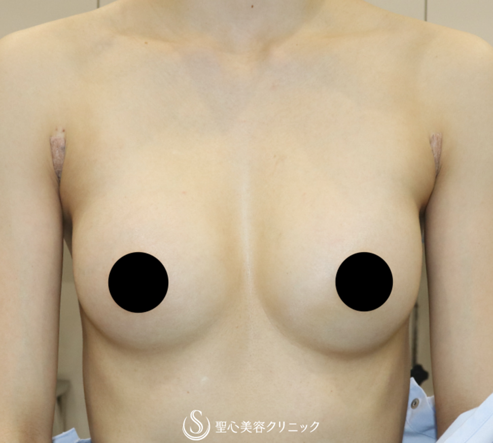 【30代女性・理想のバストを実現】バッグプロテーゼ挿入法（モティバ・エルゴノミクス2Mini155cc）（1ヶ月後） After 