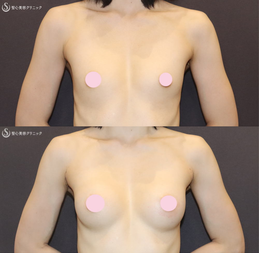【30代女性・理想のバストを実現】バッグプロテーゼ挿入法（モティバ・エルゴノミクス2Mini155cc）（1ヶ月後） After 