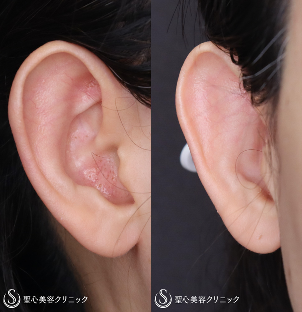 【40代女性・片側の立ち耳を治す】立ち耳修正（埋没法）（1ヶ月後） Before 