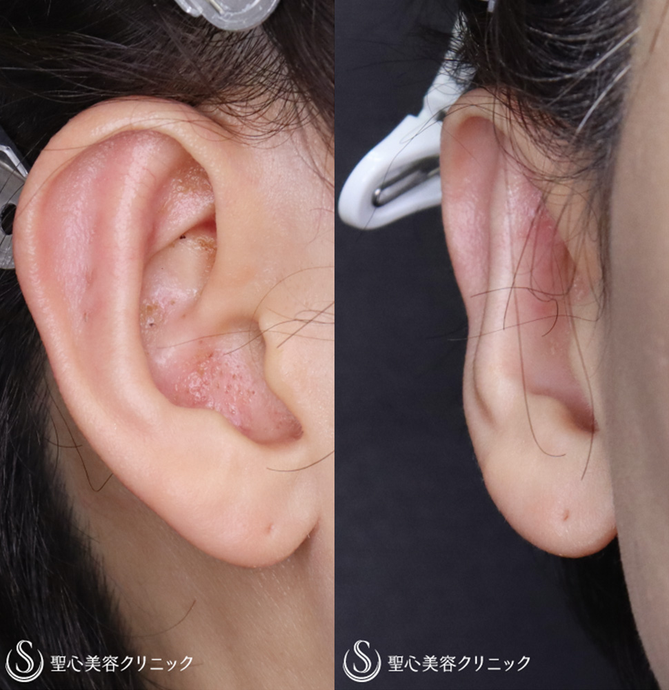 【40代女性・片側の立ち耳を治す】立ち耳修正（埋没法）（1ヶ月後） After 