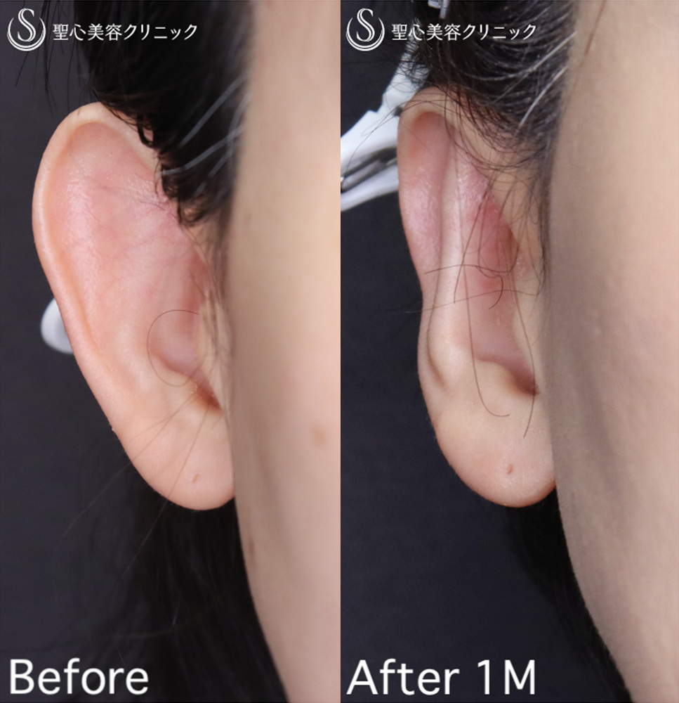 【40代女性・片側の立ち耳を治す】立ち耳修正（埋没法）（1ヶ月後） After 