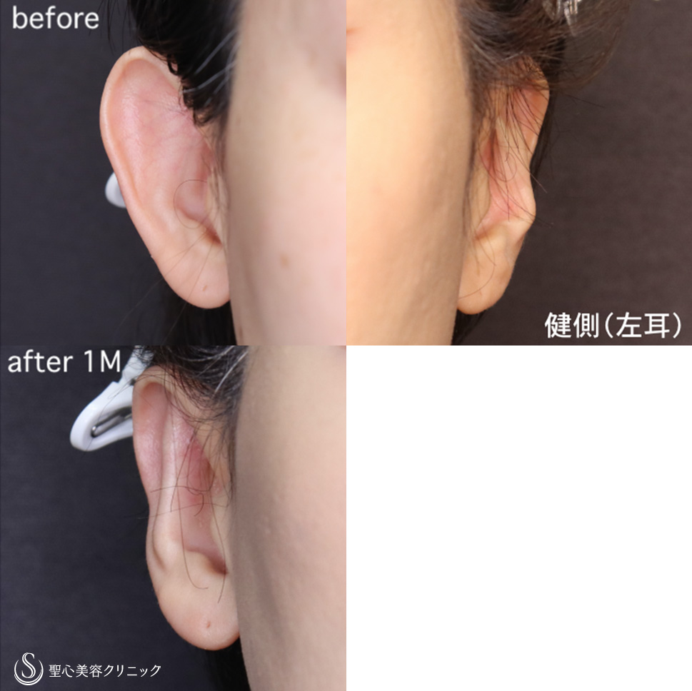 【40代女性・片側の立ち耳を治す】立ち耳修正（埋没法）（1ヶ月後） After 