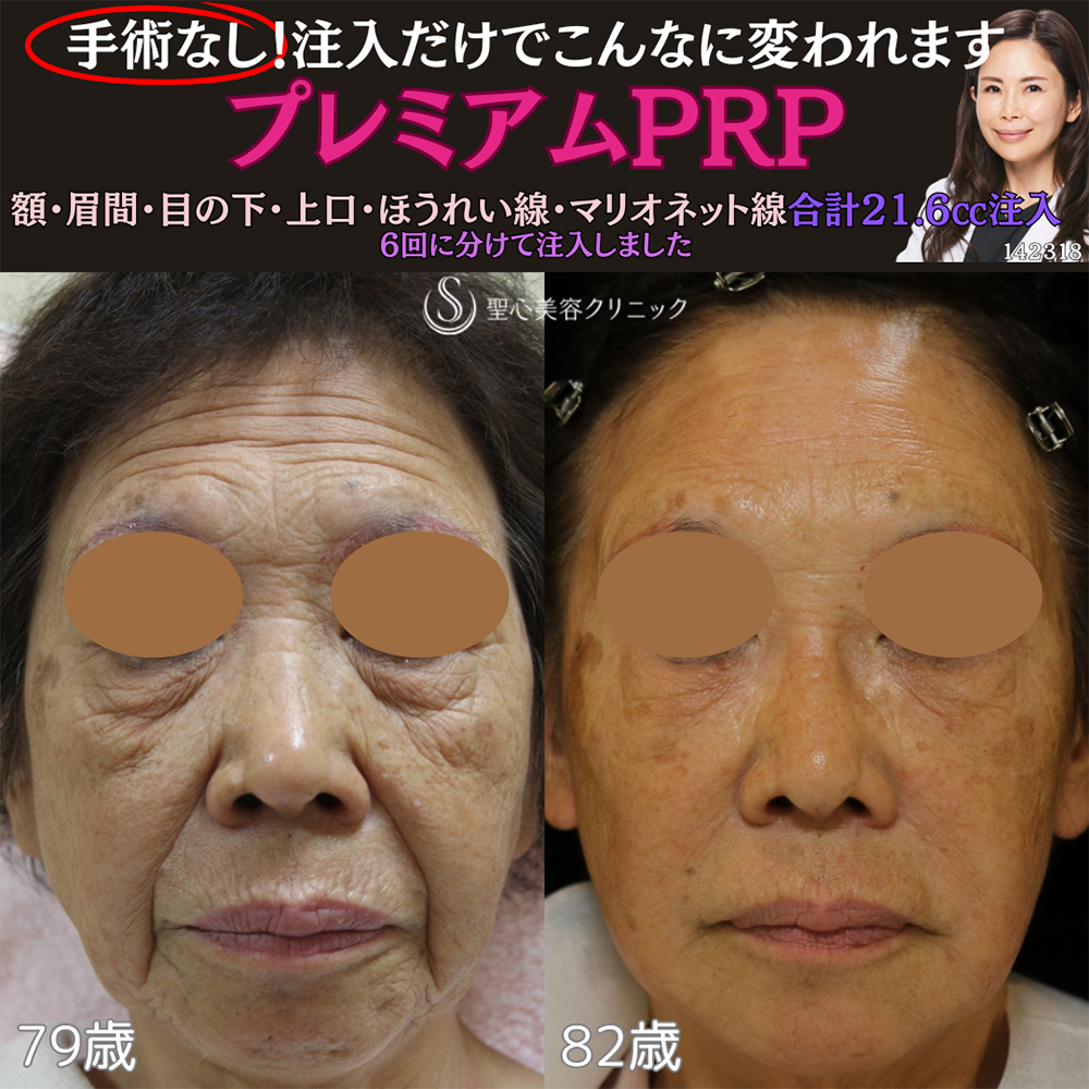 【80代女性・顔のシワたるみ】プレミアムPRP皮膚再生療法（8年後） After 