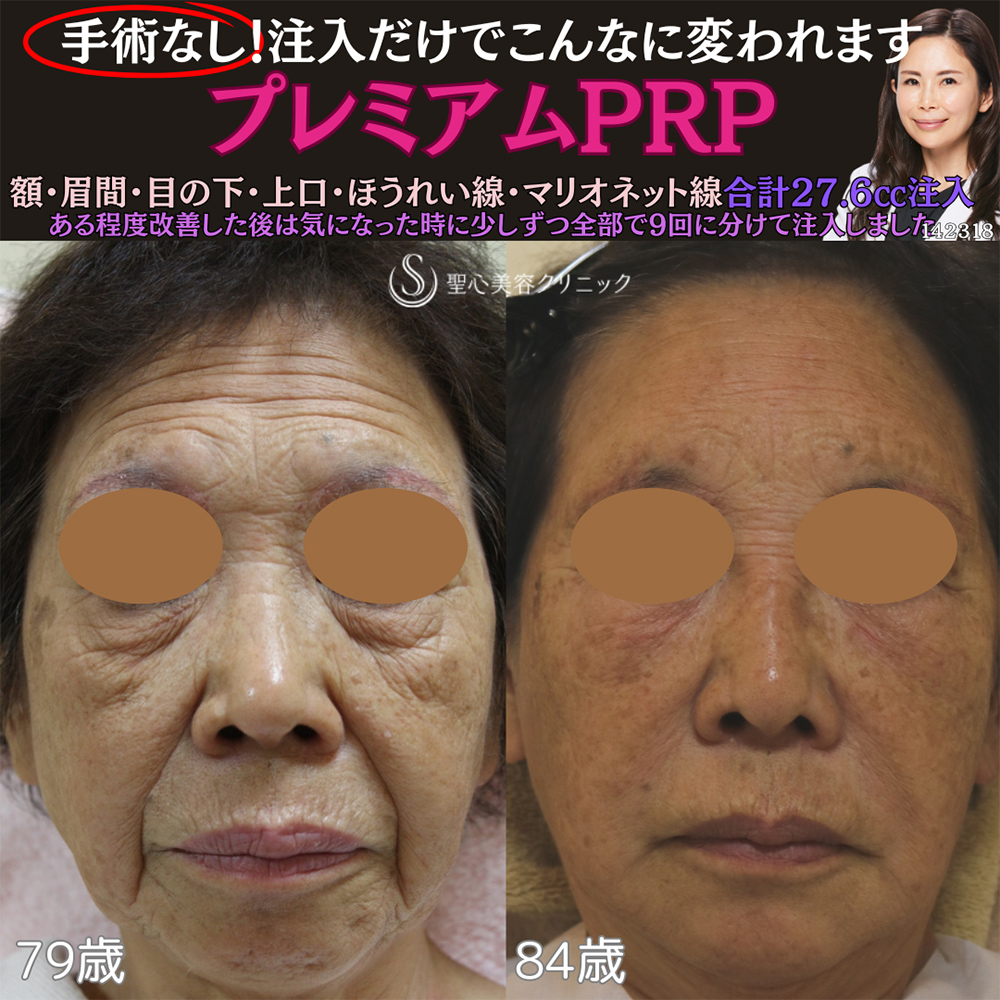 【80代女性・顔のシワたるみ】プレミアムPRP皮膚再生療法（8年後） After 