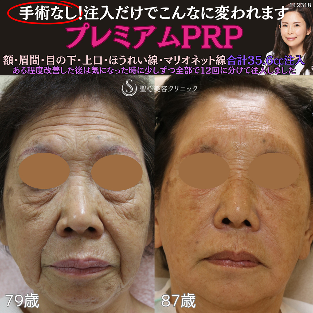 【80代女性・顔のシワたるみ】プレミアムPRP皮膚再生療法（8年後） After 