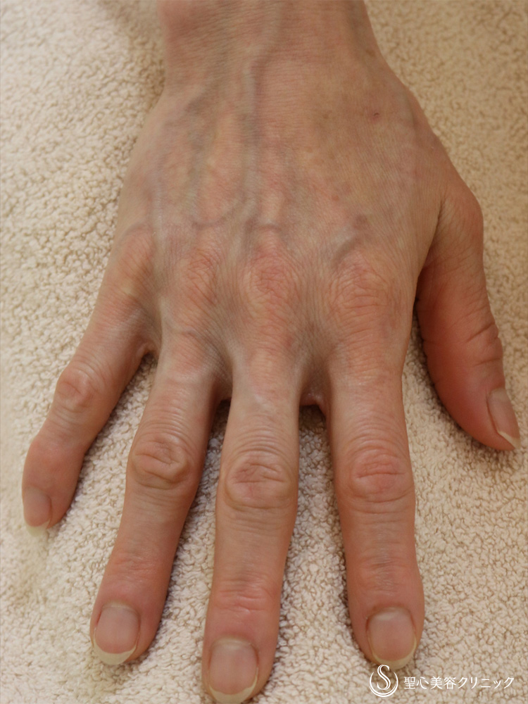【50代女性・ふっくらした手の甲に】プレミアムPRP皮膚再生療法（直後） Before 