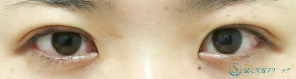 【20代女性・腫れが少なく自然な二重形成】マイクロメソッド+α（二重埋没法3点留め）（直後） After 
