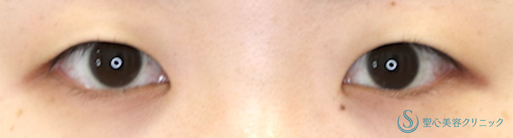 【20代女性・腫れが少なく自然な二重形成】マイクロメソッド+α（二重埋没法3点留め）（直後） Before 