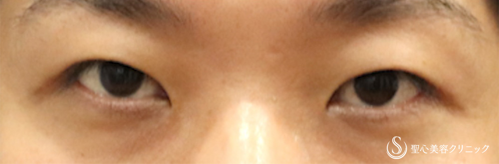 【30代男性・他院眼瞼下垂修正】二重術（切開法）＋目上切開（1週間後） Before 