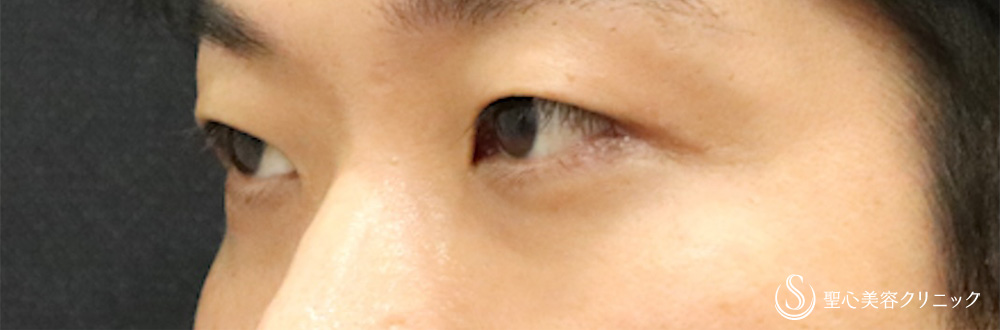【30代男性・他院眼瞼下垂修正】二重術（切開法）＋目上切開（1週間後） Before 