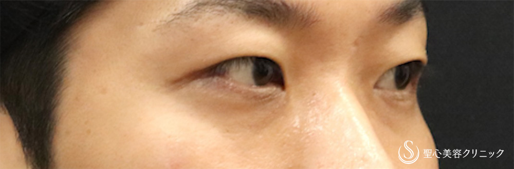 【30代男性・他院眼瞼下垂修正】二重術（切開法）＋目上切開（1週間後） Before 