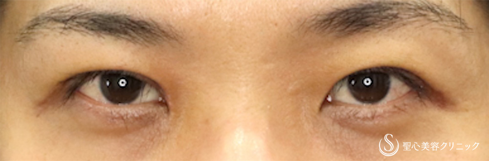 【30代男性・他院眼瞼下垂修正】二重術（切開法）＋目上切開（1週間後） After 