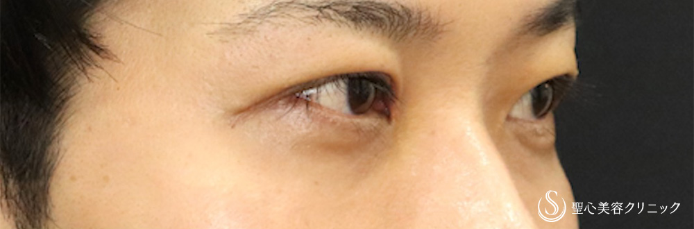 【30代男性・他院眼瞼下垂修正】二重術（切開法）＋目上切開（1週間後） After 