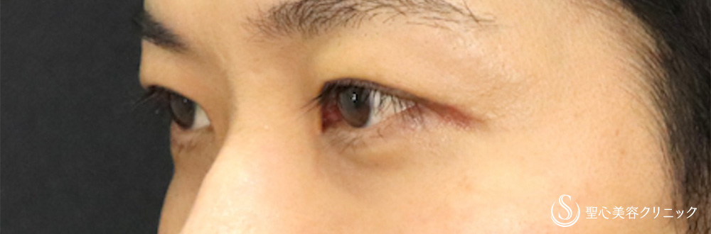 【30代男性・他院眼瞼下垂修正】二重術（切開法）＋目上切開（1週間後） After 