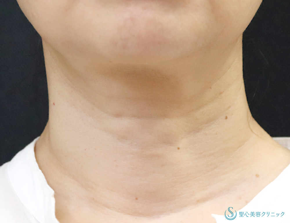 【40代女性・首のしわを薄く】プレミアムPRP皮膚再生療法（1年後） Before 