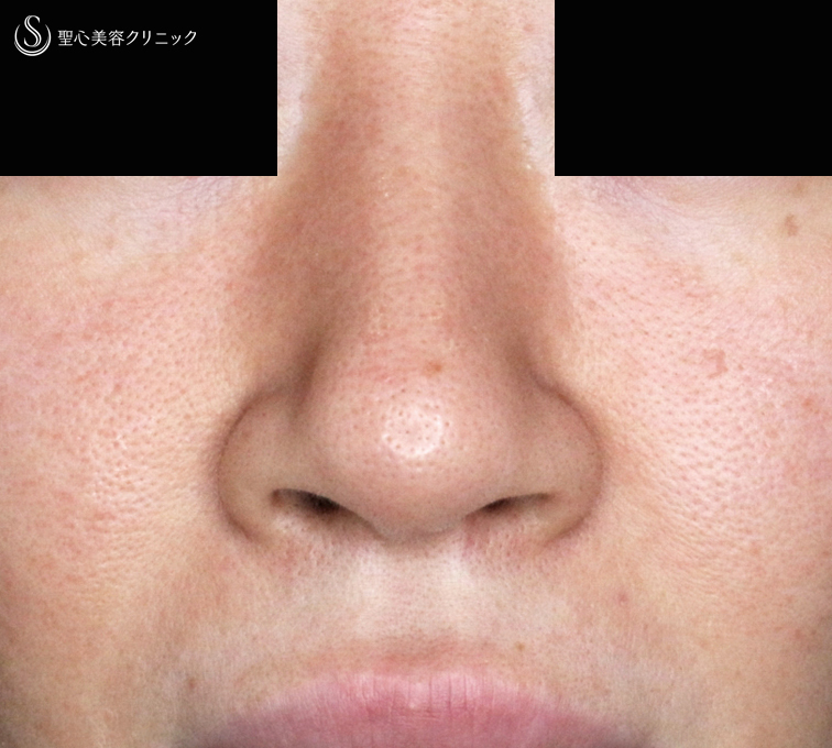 【30代女性・外を切らない最新+αで「忘れ鼻」】小鼻縮小術+α法 Ver.7.5 ＋ 鼻尖縮小術+α法 Ver.4（術直後〜3ヶ月後） Before 