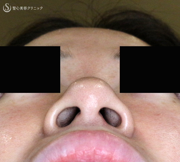 【30代女性・外を切らない最新+αで「忘れ鼻」】小鼻縮小術+α法 Ver.7.5 ＋ 鼻尖縮小術+α法 Ver.4（術直後〜3ヶ月後） Before 