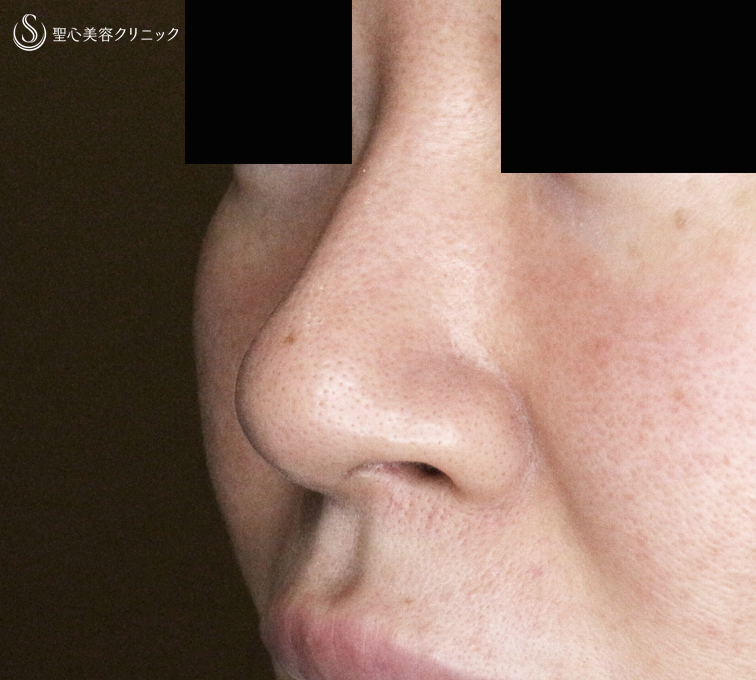 【30代女性・外を切らない最新+αで「忘れ鼻」】小鼻縮小術+α法 Ver.7.5 ＋ 鼻尖縮小術+α法 Ver.4（術直後〜3ヶ月後） Before 