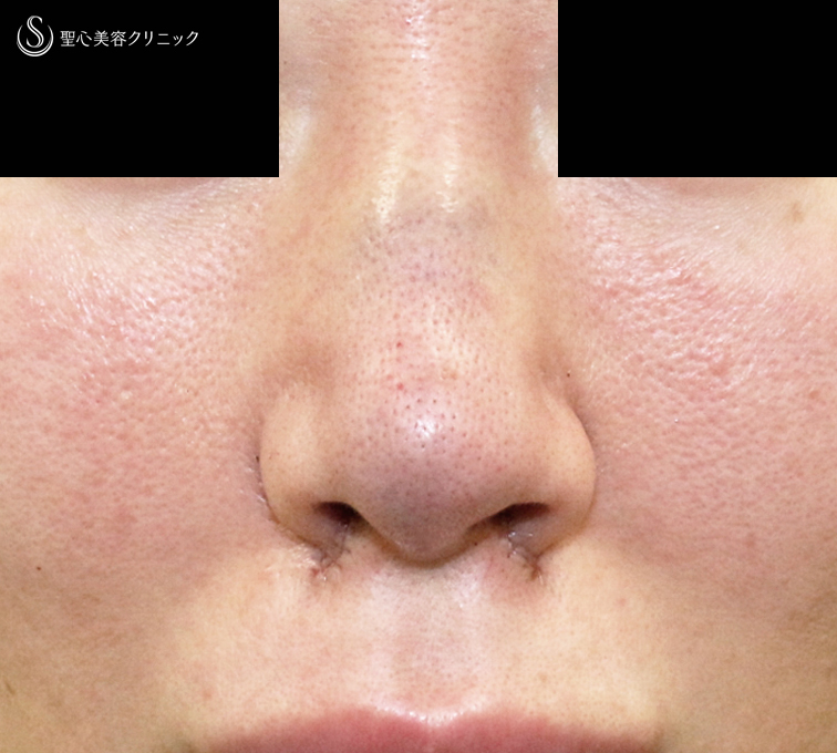 【30代女性・外を切らない最新+αで「忘れ鼻」】小鼻縮小術+α法 Ver.7.5 ＋ 鼻尖縮小術+α法 Ver.4（術直後〜3ヶ月後） Before 