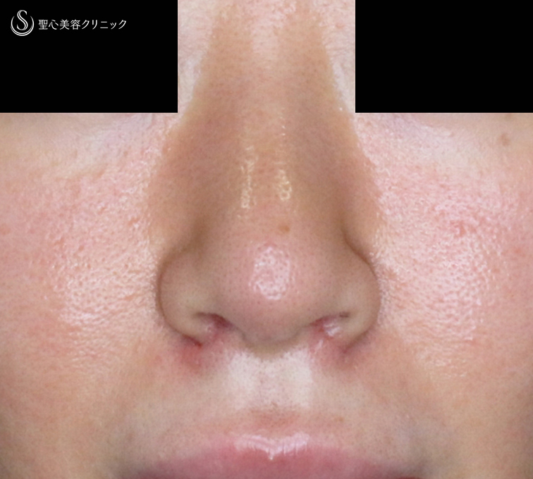 【30代女性・外を切らない最新+αで「忘れ鼻」】小鼻縮小術+α法 Ver.7.5 ＋ 鼻尖縮小術+α法 Ver.4（術直後〜3ヶ月後） After 