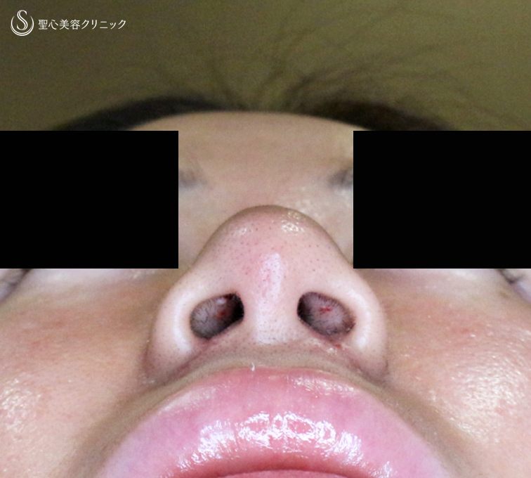 【30代女性・外を切らない最新+αで「忘れ鼻」】小鼻縮小術+α法 Ver.7.5 ＋ 鼻尖縮小術+α法 Ver.4（術直後〜3ヶ月後） After 