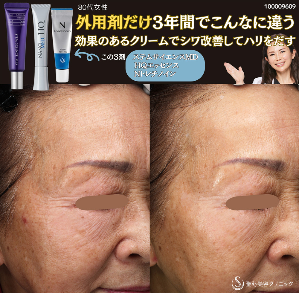 【80代女性・顔のシワくすみハリ】N-トレチノインシリーズ処方（トレチノインカプセル製剤＋ナノメッドHQエッセンス）＋ステムサイエンスM.D.（3年後） After 