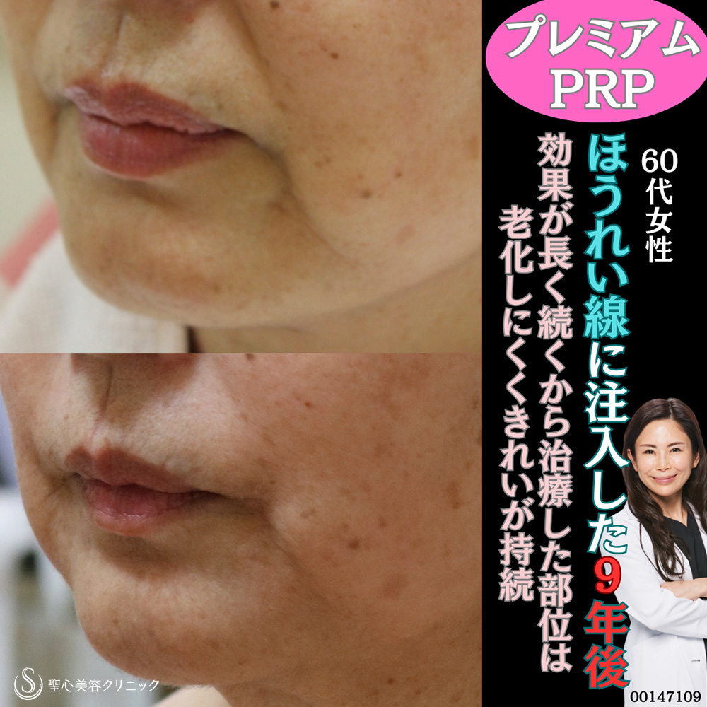 【60代女性・ほうれい線】プレミアムPRP皮膚再生療法（9年後） After 