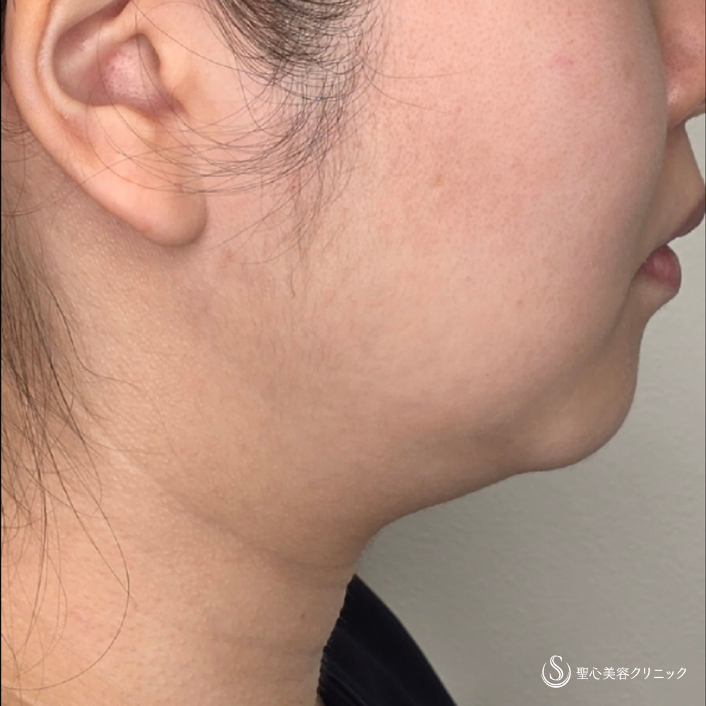 【30代女性・顎下のたるみ】ドクターハイフ（ウルトラセルQプラス）（1回後） Before 
