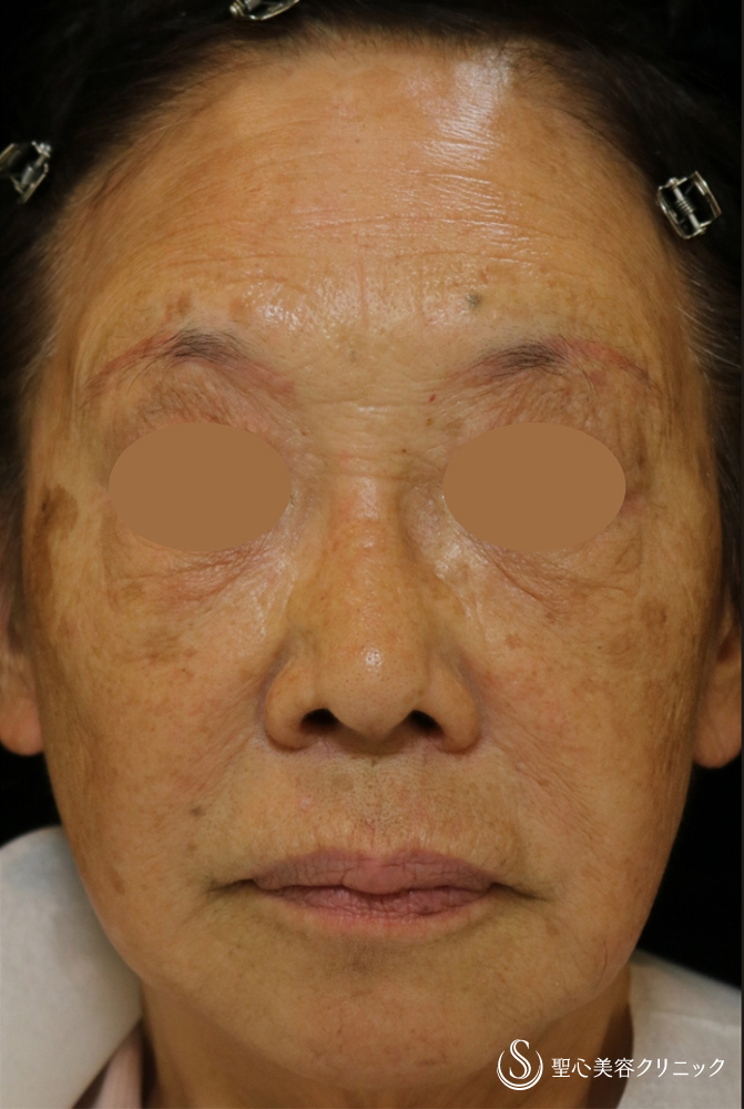 【80代女性・顔のシワたるみ】プレミアムPRP皮膚再生療法（8年後） After 
