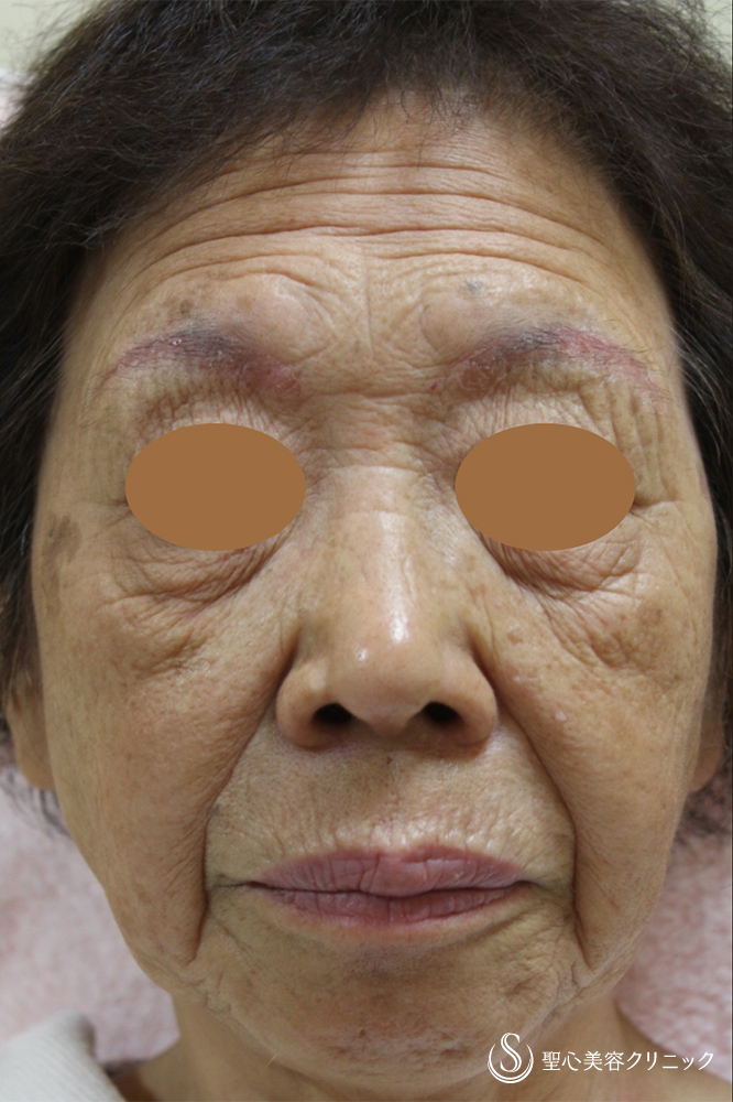 【80代女性・顔のシワたるみ】プレミアムPRP皮膚再生療法（8年後） Before 