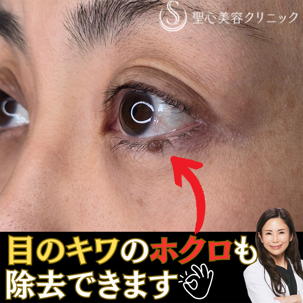 【40代女性・目のキワのホクロ】ホクロ除去 Before 