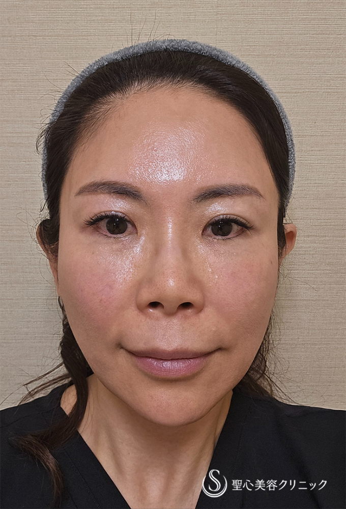【50歳女性・もっと小顔に】ドクターDENSITY（デンシティ）（1回後） After 
